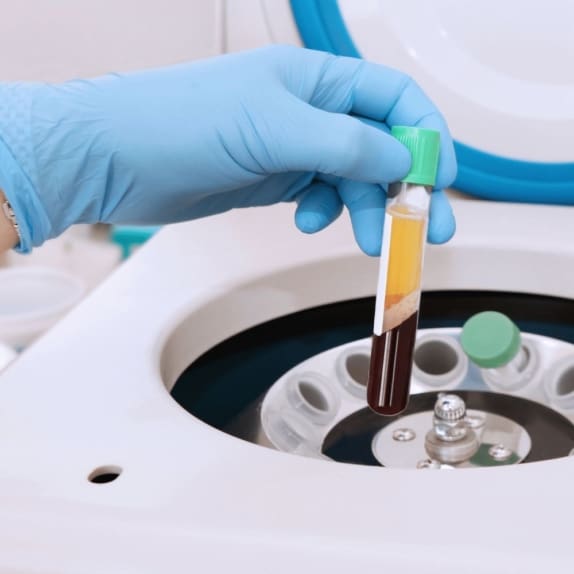 PRF (Platelet-Rich Fibrin)